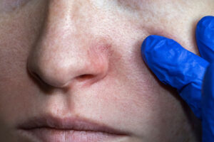 photo of a persons cocaine nose and a person touching their face while wearing a glove